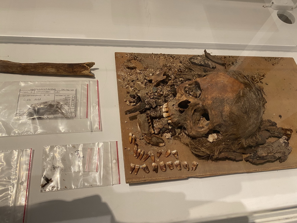 Skull with teeth and hair at the `Ziek & Gezond - Collectielab` exhibition in Room 3 at the Ground Floor of the Stedelijk Museum Breda