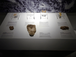 Glands with carcinoma at the Body World exhibition at the Third Floor of the Dalian Jinshitan Mystery of Life Museum, with explanation