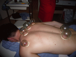 Tim having a Chinese cupping massage at a massage salon in the city center