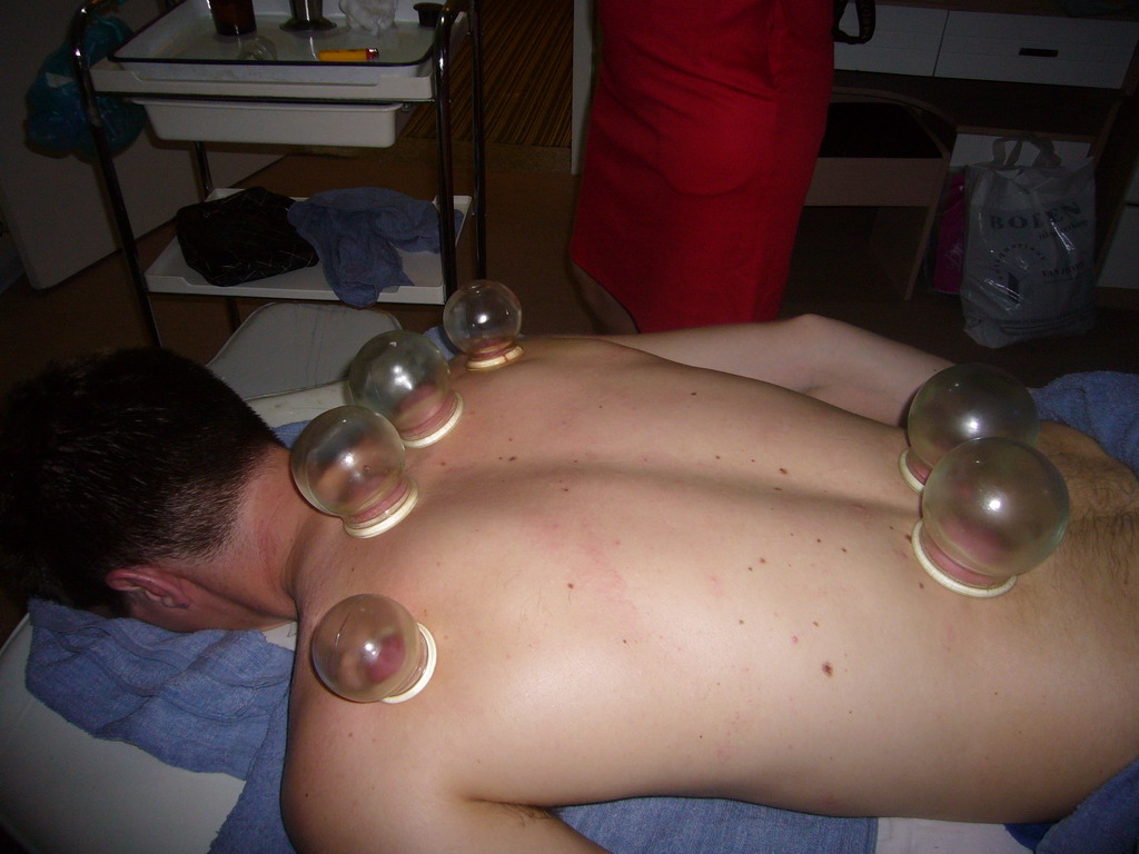 Tim having a Chinese cupping massage at a massage salon in the city center