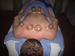 Tim having a Chinese cupping massage at a massage salon in the city center