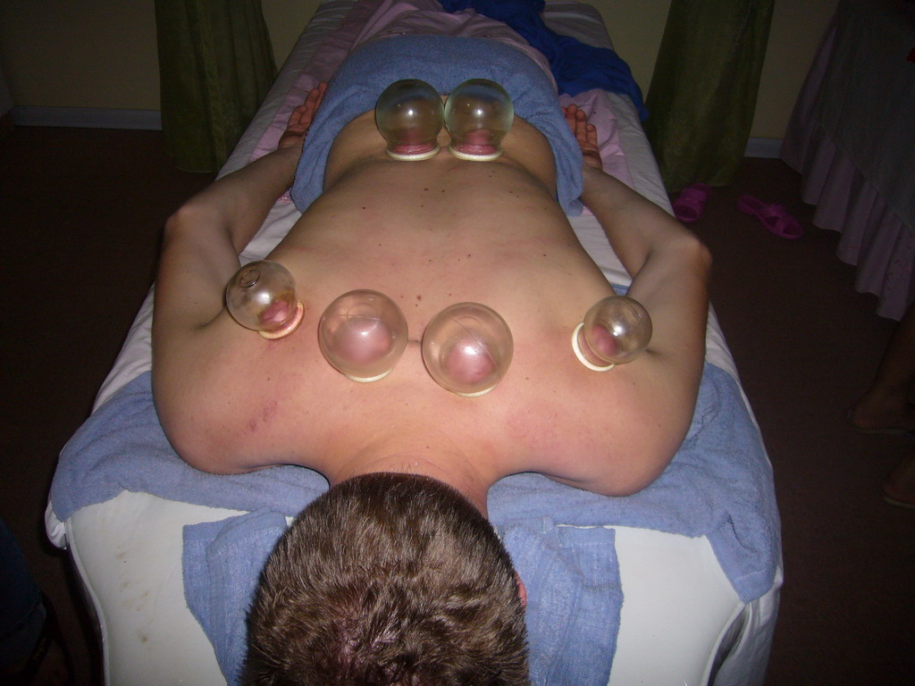 Tim having a Chinese cupping massage at a massage salon in the city center