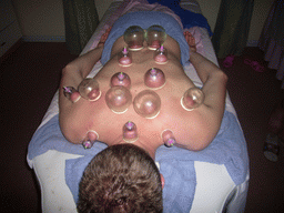 Tim having a Chinese cupping massage at a massage salon in the city center