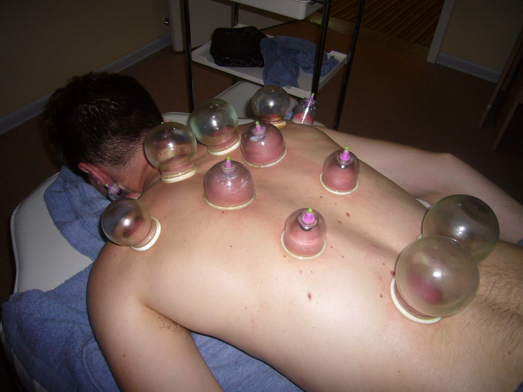 Tim having a Chinese cupping massage at a massage salon in the city center