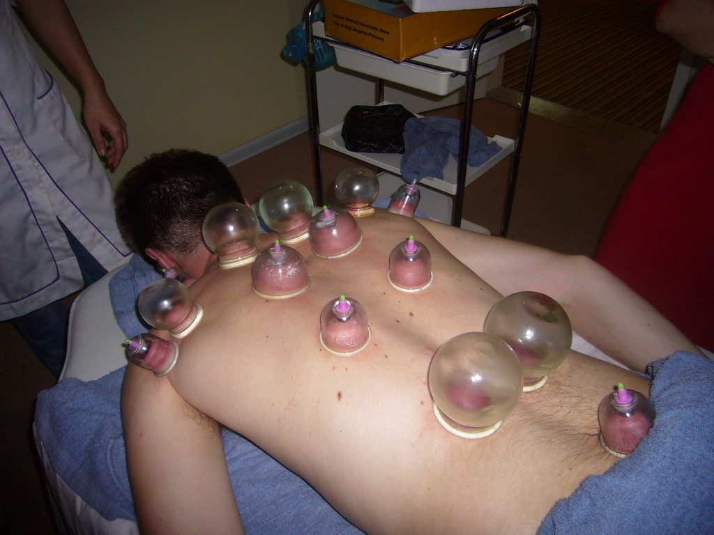 Tim having a Chinese cupping massage at a massage salon in the city center