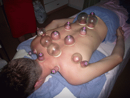 Tim having a Chinese cupping massage at a massage salon in the city center