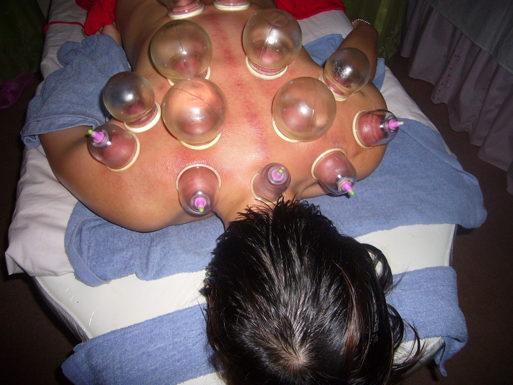 Miaomiao having a Chinese cupping massage at a massage salon in the city center